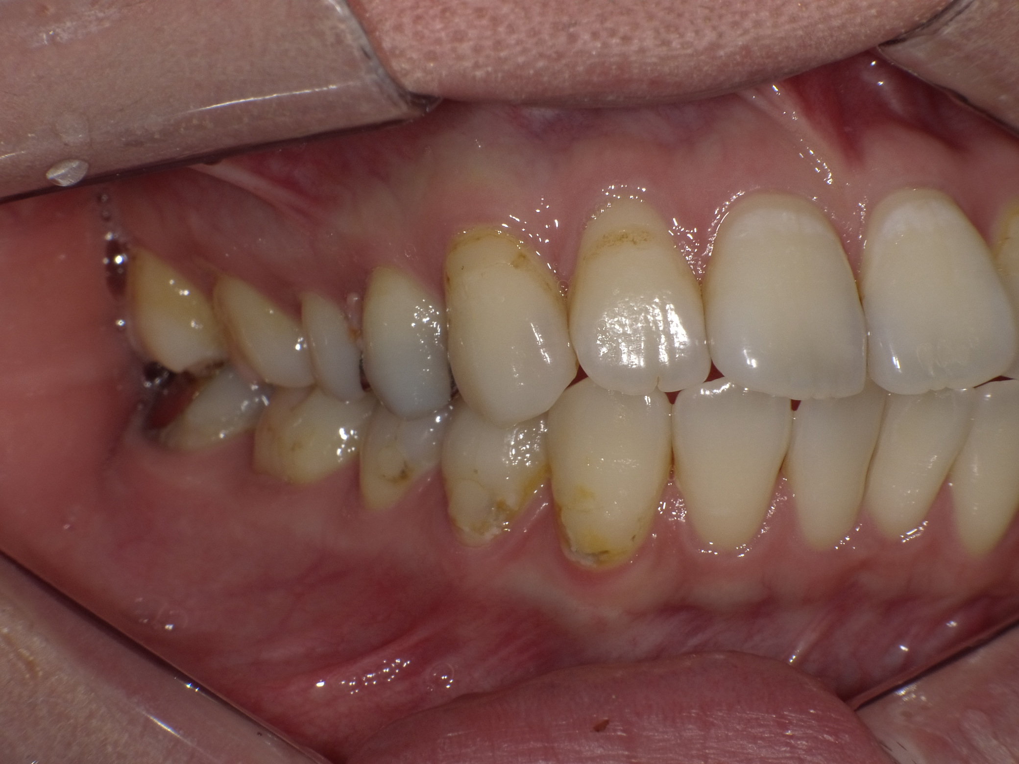 虫歯before