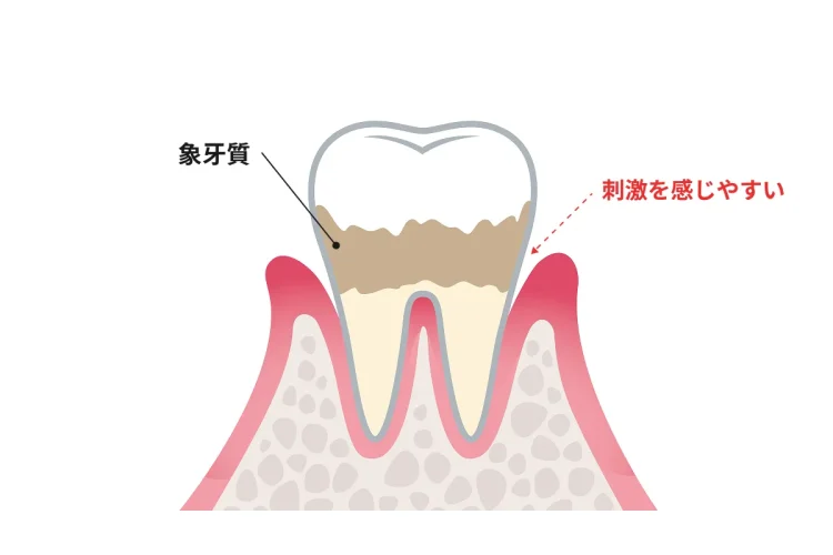 知覚過敏のイメージ