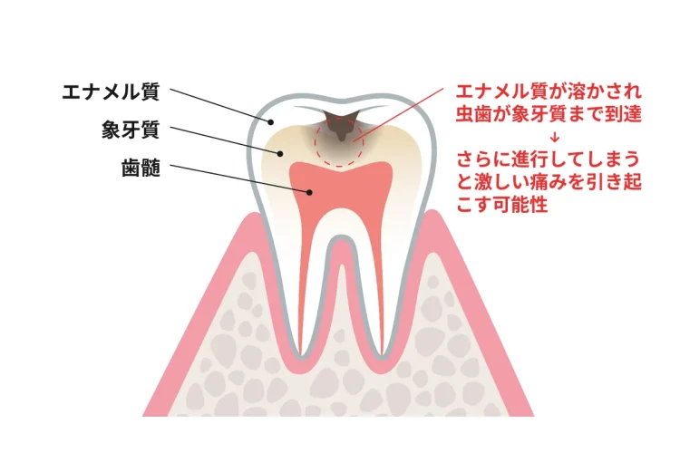 虫歯のイメージ