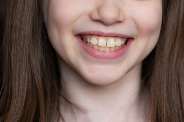 出っ歯（上顎前突）の矯正治療｜原因・治し方・費用を専門医が徹底解説 画像