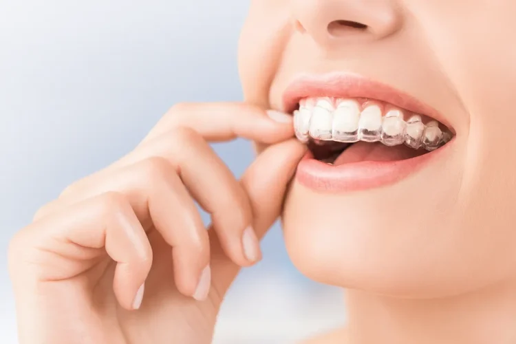 マウスピース矯正